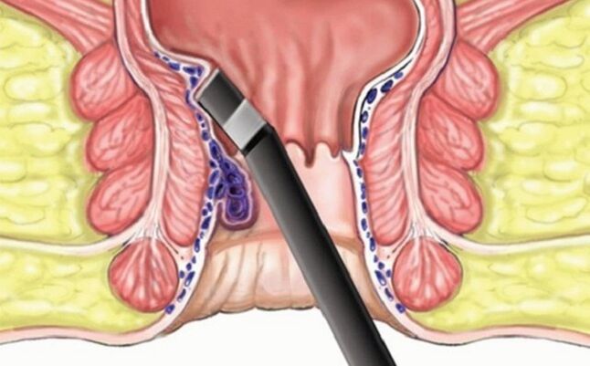 Gerinnung von Hämorrhoiden in Hämorrhoiden